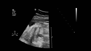 Fetal ekokardiyografi ile ultrasonografi ekranı.