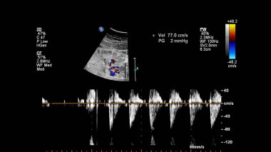 Fetal ekokardiyografi ile ultrasonografi ekranı.