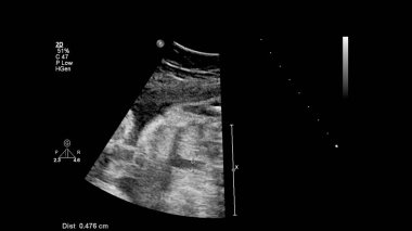 Fetal ekokardiyografi ile ultrasonografi ekranı.