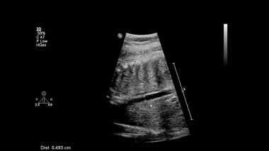 Fetal ekokardiyografi ile ultrasonografi ekranı.