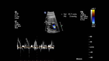 Fetal ekokardiyografi ile ultrasonografi ekranı.