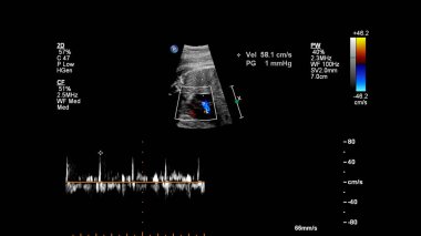 Fetal ekokardiyografi ile ultrasonografi ekranı.