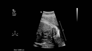Fetal ekokardiyografi ile ultrasonografi ekranı.