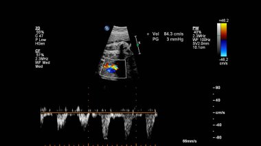 Fetal ekokardiyografi ile ultrasonografi ekranı.