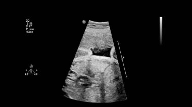 Fetal ekokardiyografi ile ultrasonografi ekranı.