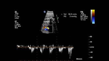 Fetal ekokardiyografi ile ultrasonografi ekranı.