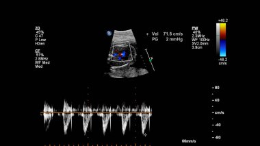 Fetal ekokardiyografi ile ultrasonografi ekranı.