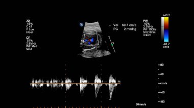 Fetal ekokardiyografi ile ultrasonografi ekranı.