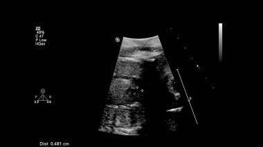 Fetal ekokardiyografi ile ultrasonografi ekranı.