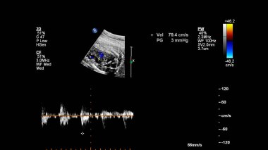 Fetal ekokardiyografi ile ultrasonografi ekranı.