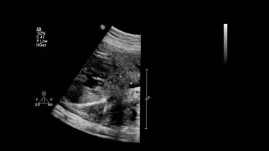 Fetal ekokardiyografi ile ultrasonografi ekranı.