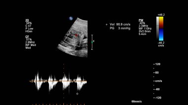 Fetal ekokardiyografi ile ultrasonografi ekranı.