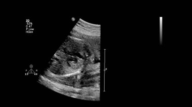 Fetal ekokardiyografi ile ultrasonografi ekranı.