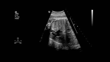 Fetal ekokardiyografi ile ultrasonografi ekranı.