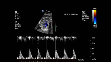 Fetal ekokardiyografi ile ultrasonografi ekranı.