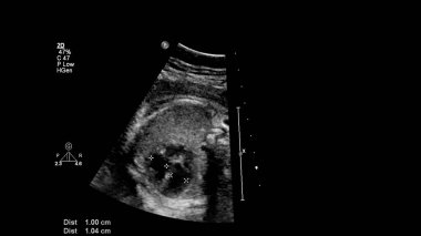 Fetal ekokardiyografi ile ultrasonografi ekranı.