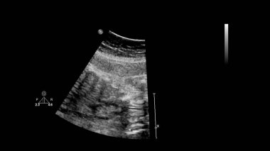 Fetal ekokardiyografi ile ultrasonografi ekranı.