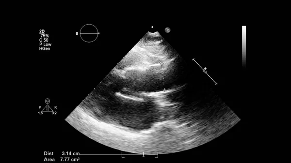 Image Heart Gray Scale Mode Transesophageal Ultrasound — Stock Photo, Image