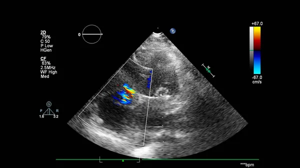 Изображение Сердца Время Трансофагеального Ультразвука Доплеровским Режимом — стоковое фото