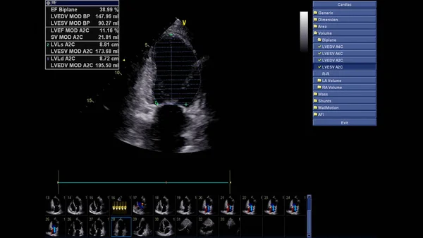 Image Heart Gray Scale Mode Transesophageal Ultrasound — Stock Photo, Image