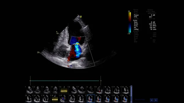 Kép Szív Alatt Transesophagealis Ultrahang Doppler Módban — Stock Fotó