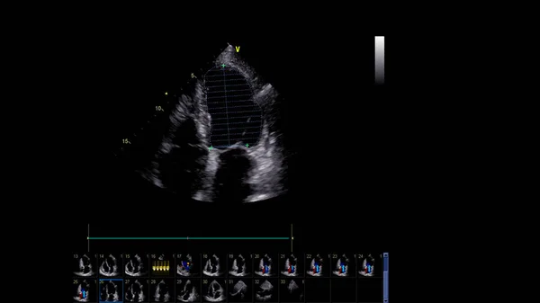 Зображення Серця Сіро Масштабному Режимі Під Час Ультразвукового Дослідження — стокове фото