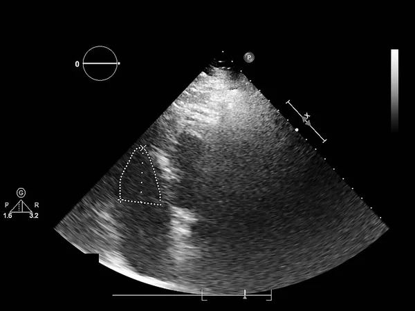 Kép Szív Szürke Skála Mód Során Transesophagealis Ultrahang — Stock Fotó