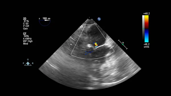 Obraz Serca Podczas Przełyku Usg Trybem Dopplera — Zdjęcie stockowe