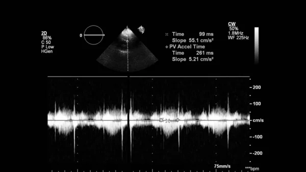 Image Heart Gray Scale Mode Transesophageal Ultrasound — Stock Photo, Image