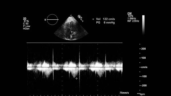 Obrázek Srdce Šedém Měřítku Během Transesofageálního Ultrazvuku — Stock fotografie