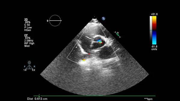 Transesofageal Ultrason Sırasında Doppler Kipi Ile Kalbin Görüntüsü — Stok fotoğraf