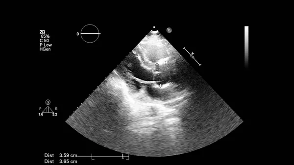 Image of the heart in gray-scale mode during transesophageal ultrasound.