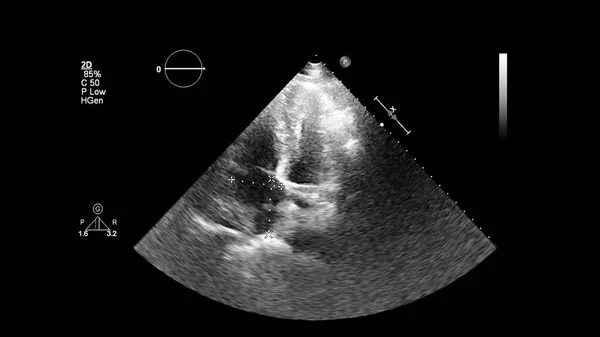 Изображение Сердца Сером Режиме Время Трансофагеального Ультразвука — стоковое фото