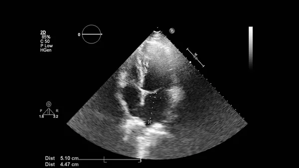 Image Cœur Mode Gris Lors Une Échographie Transœsophagienne — Photo