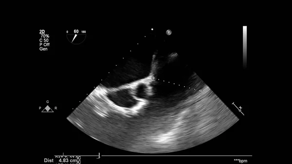 Image Cœur Mode Gris Lors Une Échographie Transœsophagienne — Photo