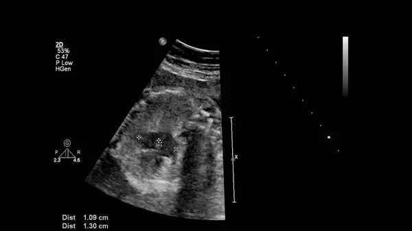 Ecrã Ultrassonográfico Com Ecocardiografia Fetal — Fotografia de Stock