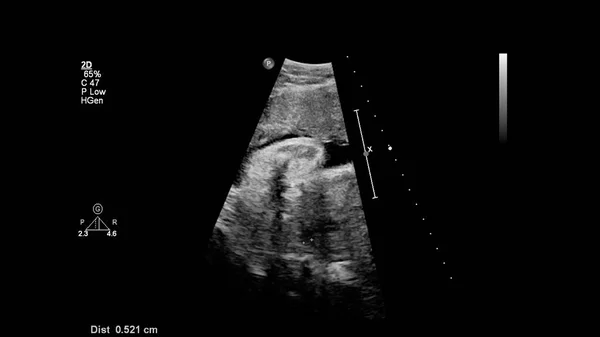 Ecrã Ultrassonográfico Com Ecocardiografia Fetal — Fotografia de Stock