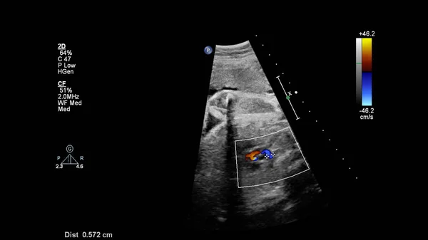 Ecrã Ultrassonográfico Com Ecocardiografia Fetal — Fotografia de Stock