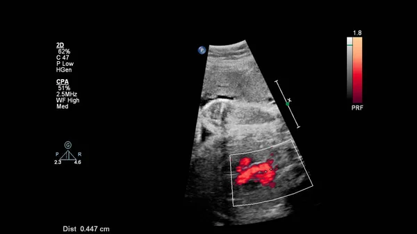 Ecrã Ultrassonográfico Com Ecocardiografia Fetal — Fotografia de Stock