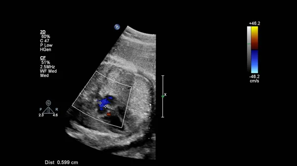 Fetal Ekokardiyografi Ile Ultrasonografi Ekranı — Stok fotoğraf