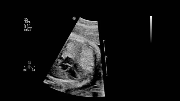 胎児心エコー検査付き超音波スクリーン — ストック写真
