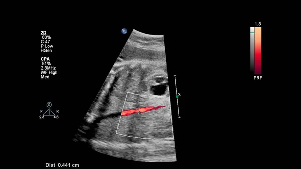 Echografie Scherm Met Foetale Echocardiografie — Stockfoto