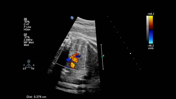 Echografie Scherm Met Foetale Echocardiografie — Stockfoto