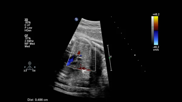 Schermo Ultrasuoni Con Ecocardiografia Fetale — Foto Stock