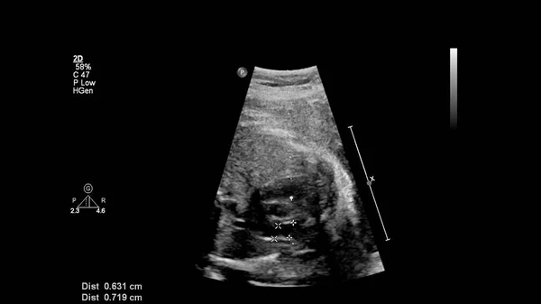 Ecrã Ultrassonográfico Com Ecocardiografia Fetal — Fotografia de Stock