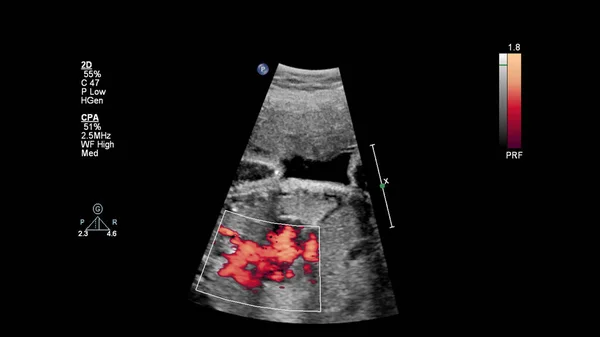 胎児心エコー検査付き超音波スクリーン — ストック写真