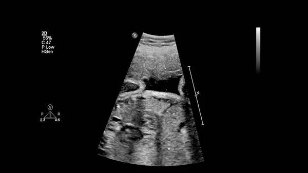 Ecrã Ultrassonográfico Com Ecocardiografia Fetal — Fotografia de Stock