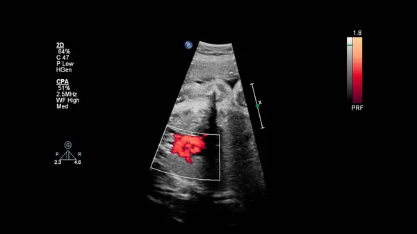 Ecrã Ultrassonográfico Com Ecocardiografia Fetal — Fotografia de Stock