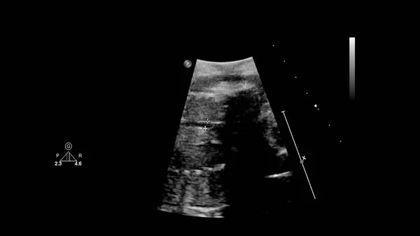 Υπερηχογραφική Οθόνη Εμβρυϊκή Ηχοκαρδιογραφία — Φωτογραφία Αρχείου
