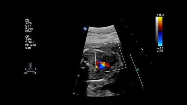 Ecrã Ultrassonográfico Com Ecocardiografia Fetal — Fotografia de Stock